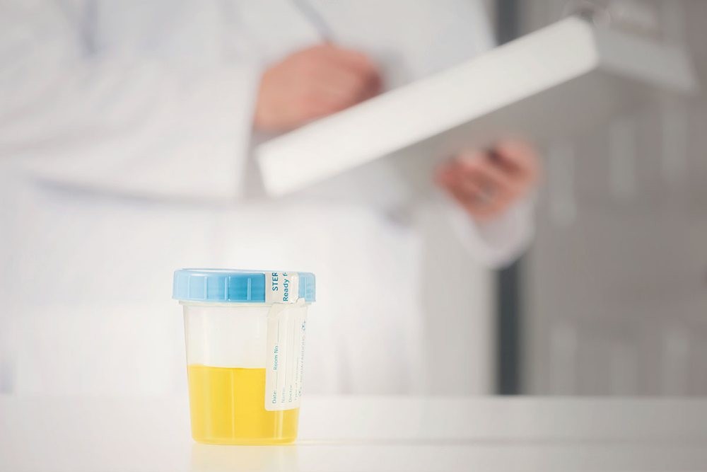 Νέα έρευνα για πρώιμη διάγνωση με απλή ουρολογική εξέταση